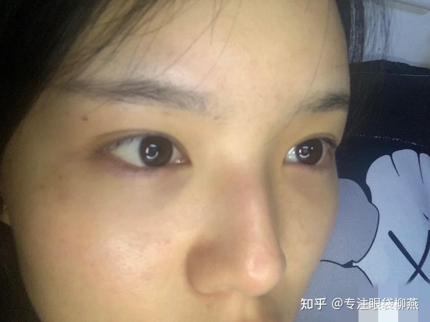 北京外切眼袋记录（分享） - 知乎