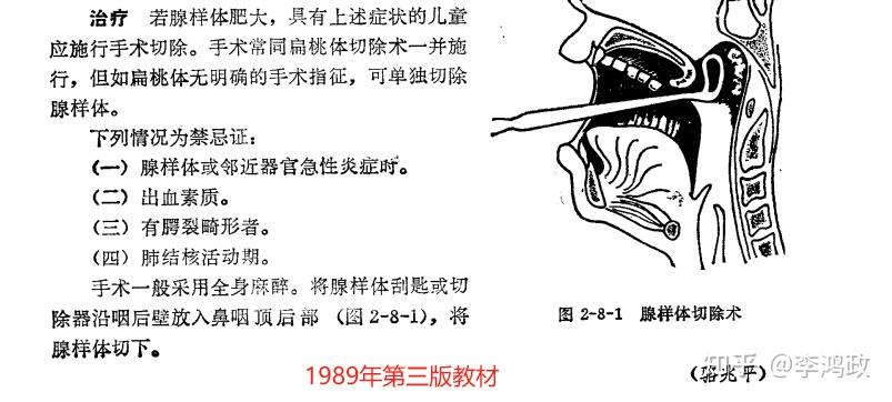 腺樣體肥大準備手術了麼看完這篇文章再做決定吧