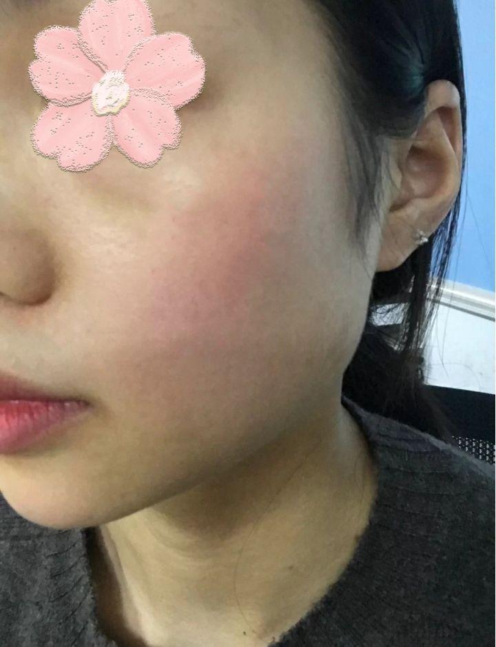 一到换季我就,尤其是我这种换季就容易过敏的肤质来说,吹吹风我就开始