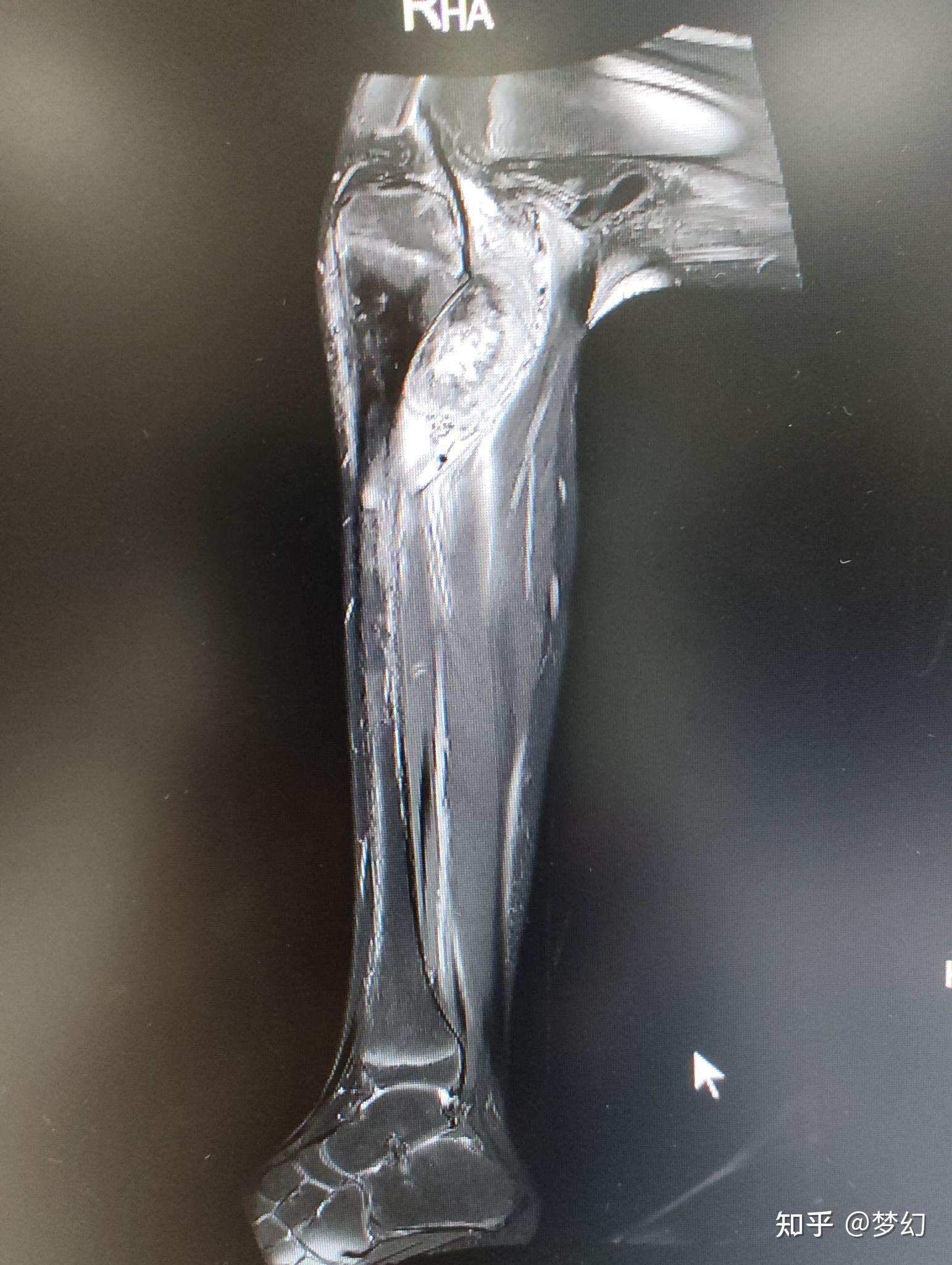 小腿骨肿瘤图片图片