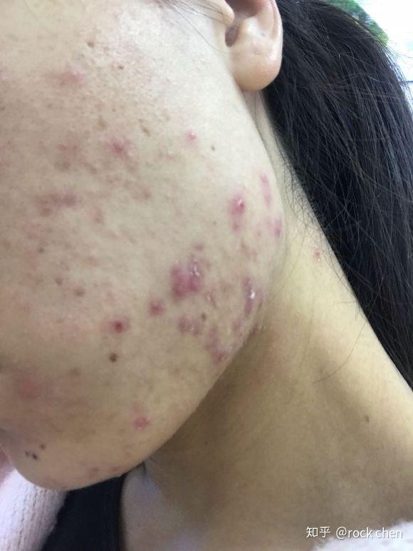 下巴两侧有结节性的痘痘? - 知乎