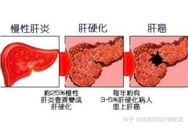 肝癌是什么原因引起的图片