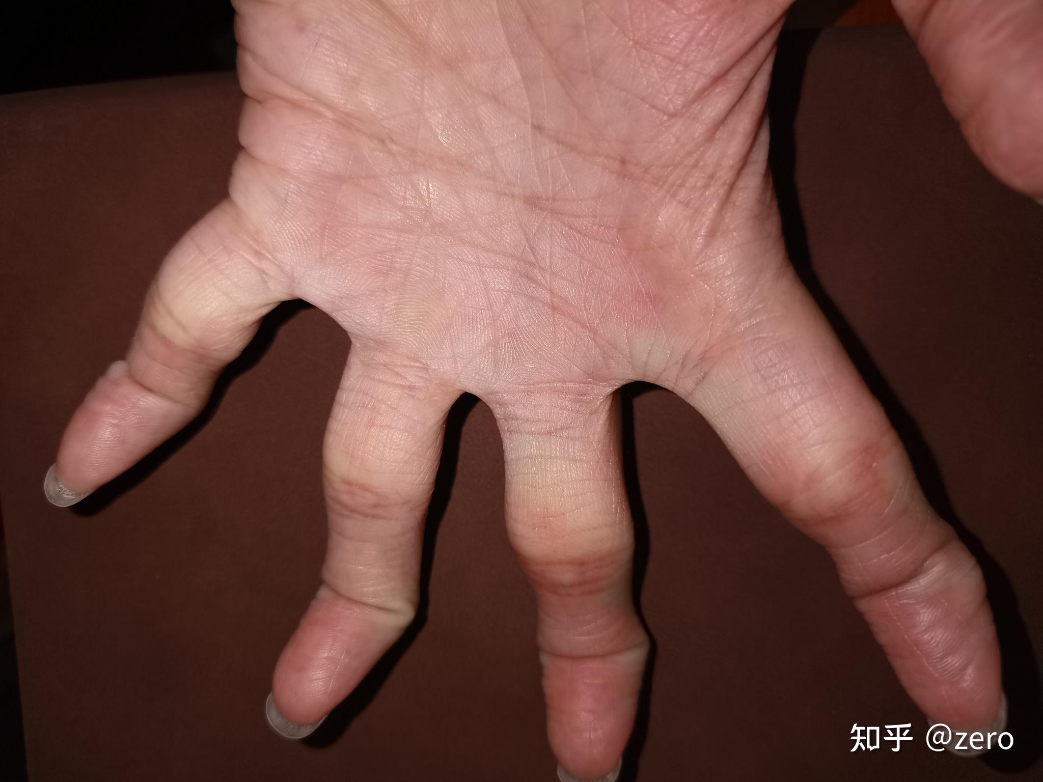 请问我的手为什么能做出手指第一节单独弯曲这样的动作这是否是一种