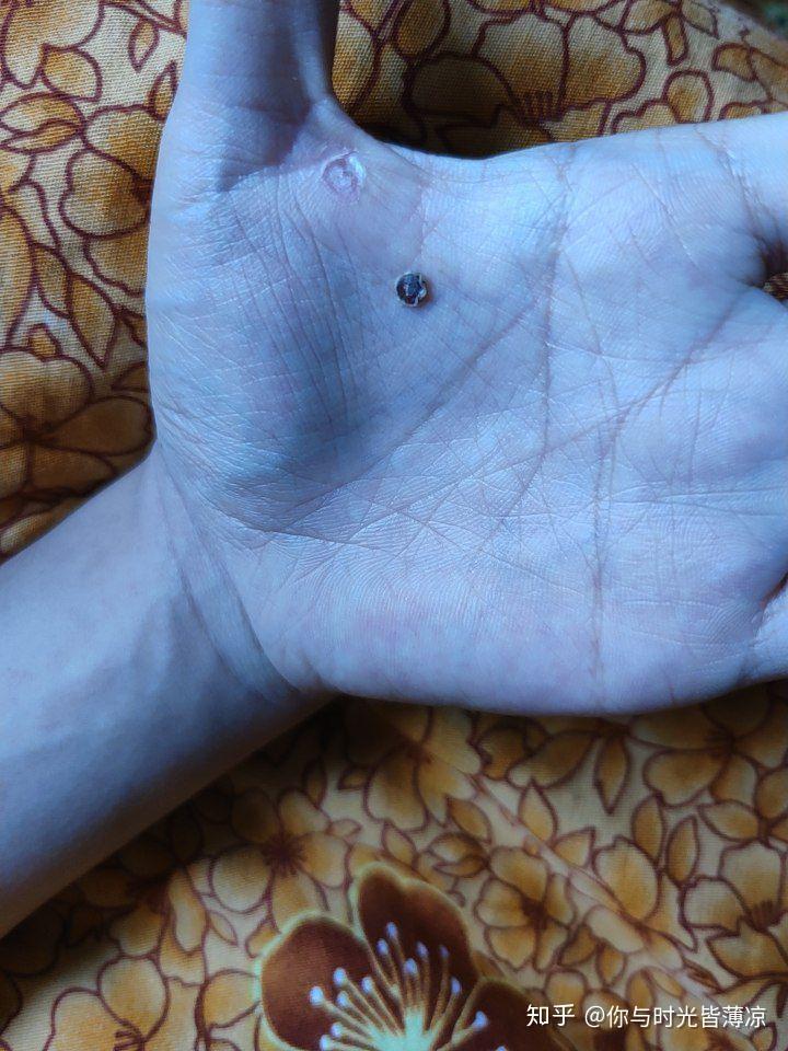 液氮冷冻治疗后手指上出了血泡而且越来越大该怎么办? - 知乎