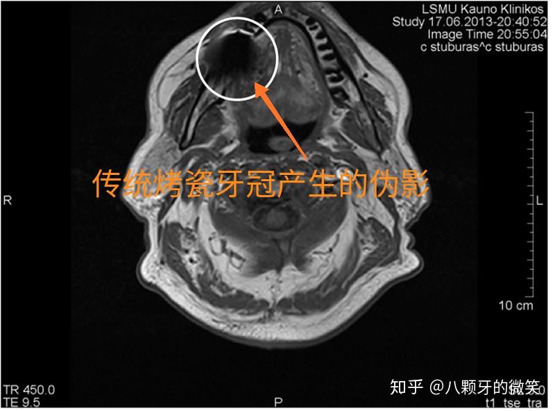 需要做头部核磁共振检查，我的假牙需要取下来吗？？？ 知乎