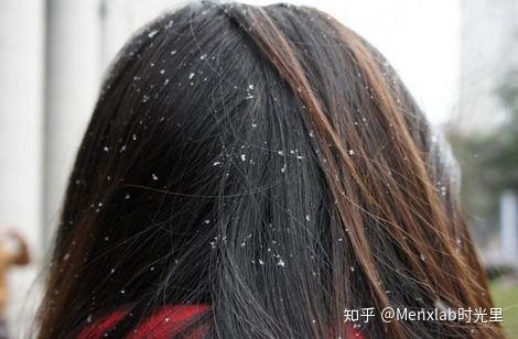 你为什么会有这么多头皮屑? - 知乎
