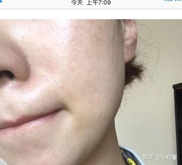 闭口真的强烈推荐这个辣美水杨酸面膜 知乎