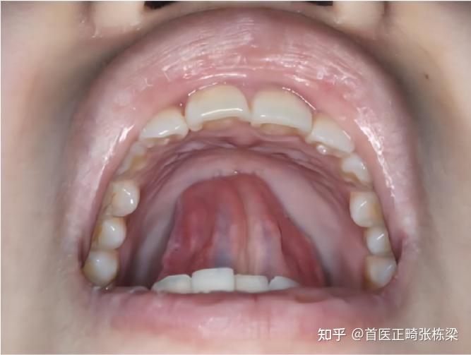 儿童口呼吸、反颌舌肌、唇肌功能训练大全，家长必看！ - 知乎
