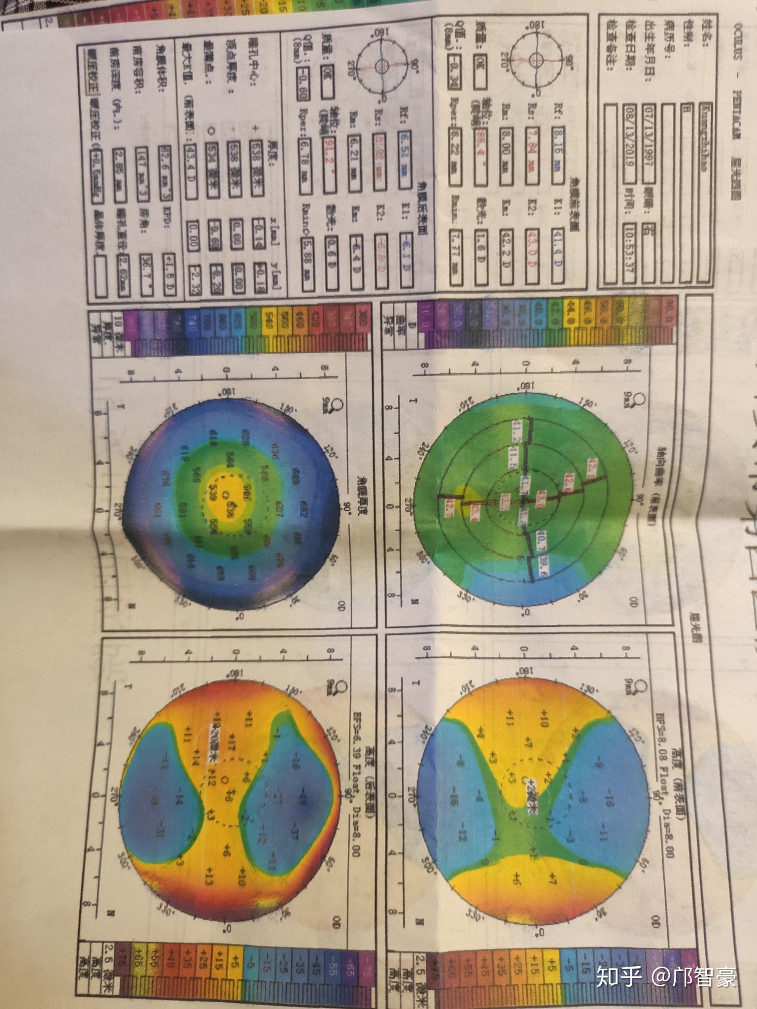 请大神看一下角膜地形图,是不是不规则散光,晚上看东西上下重影?