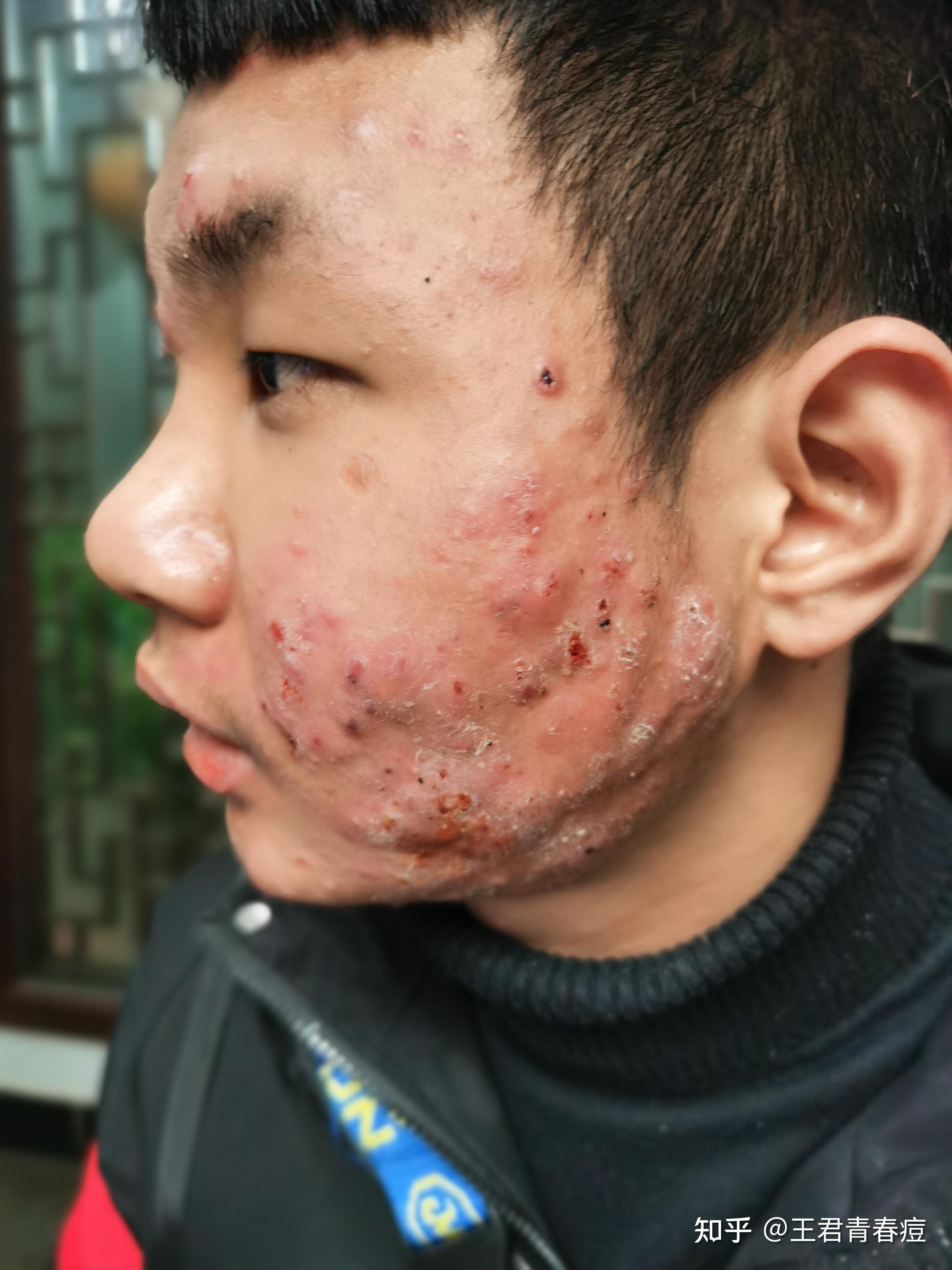 脸上痘痘很严重怎么办? - 知乎
