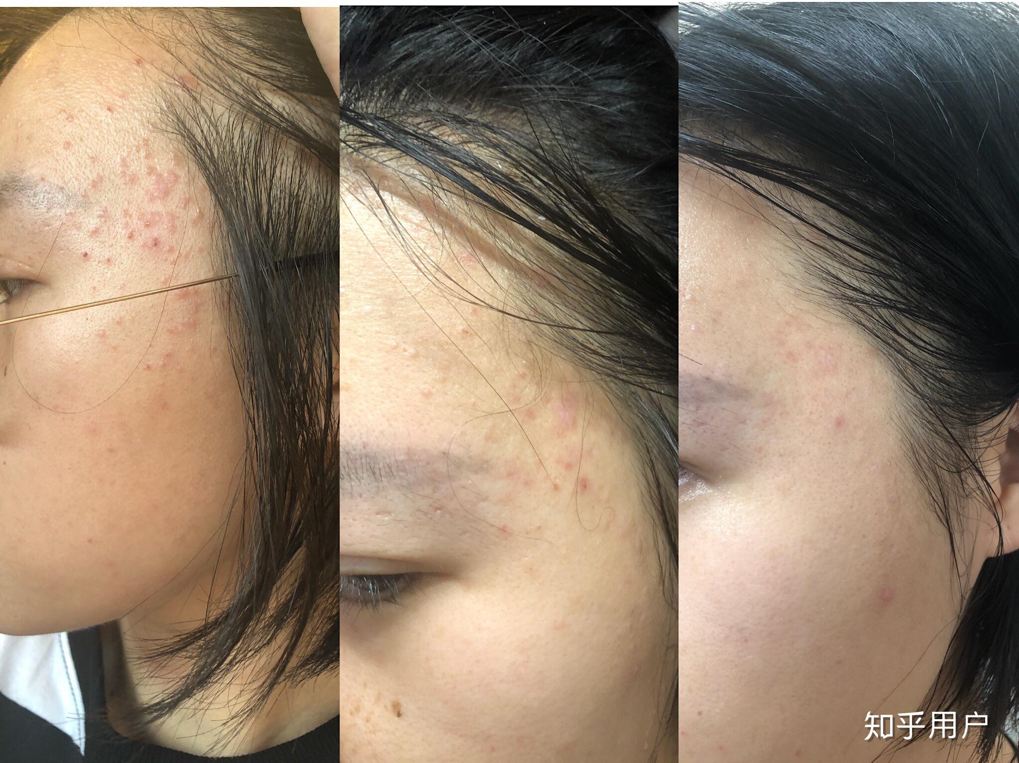 扁平疣有治愈的方法么