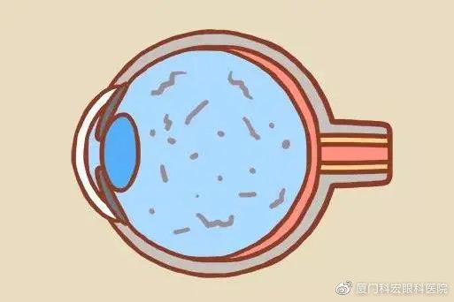 眼睛出现闪光感,究竟是怎么回事? - 知乎