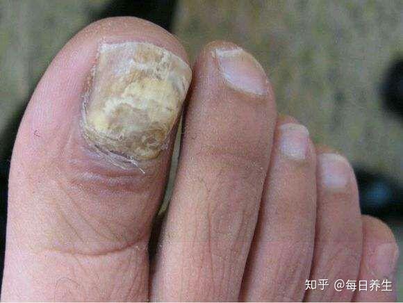 看图识脚病你是哪一种