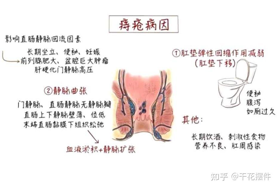 化痔栓怎么塞图解图片