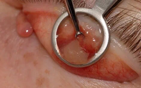 宝宝这是霰粒肿还是麦粒肿? - 知乎