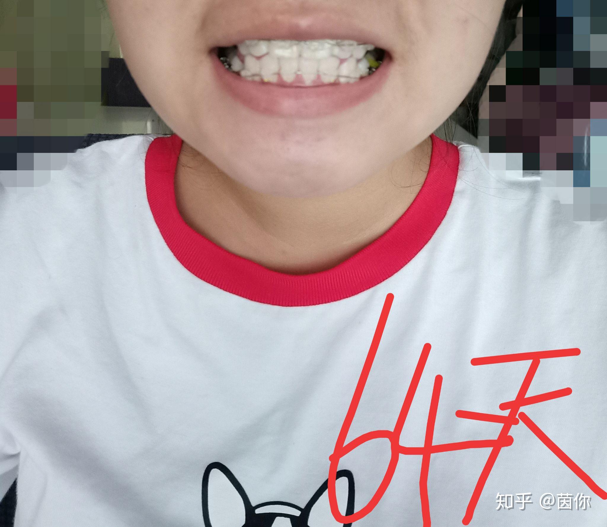 戴牙套一般要多久 zhuanlan.zhihu.com