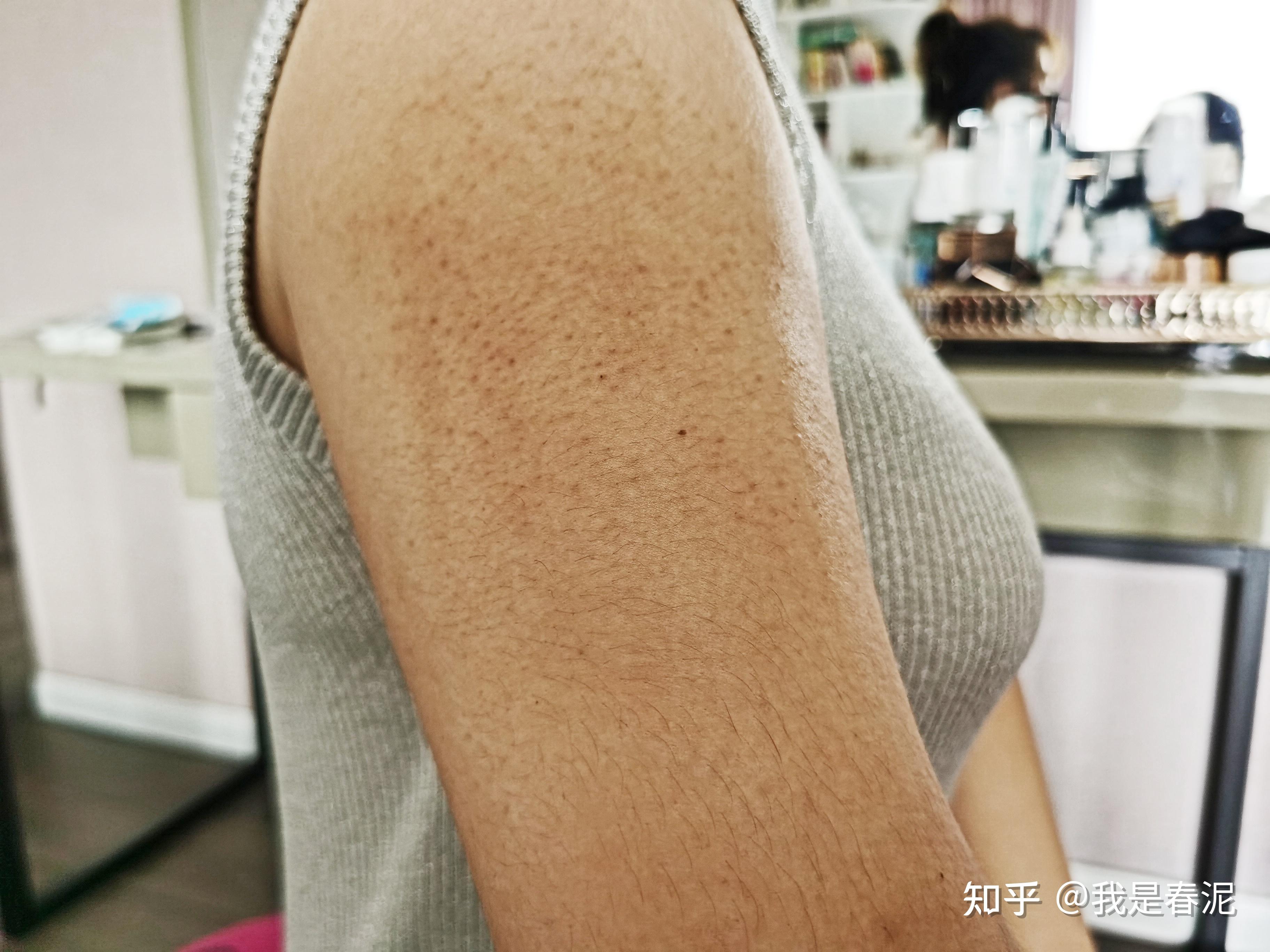 当时我的鸡皮还蛮严重的,已经变成黑黑的,看起来一片片的斑,胳膊和