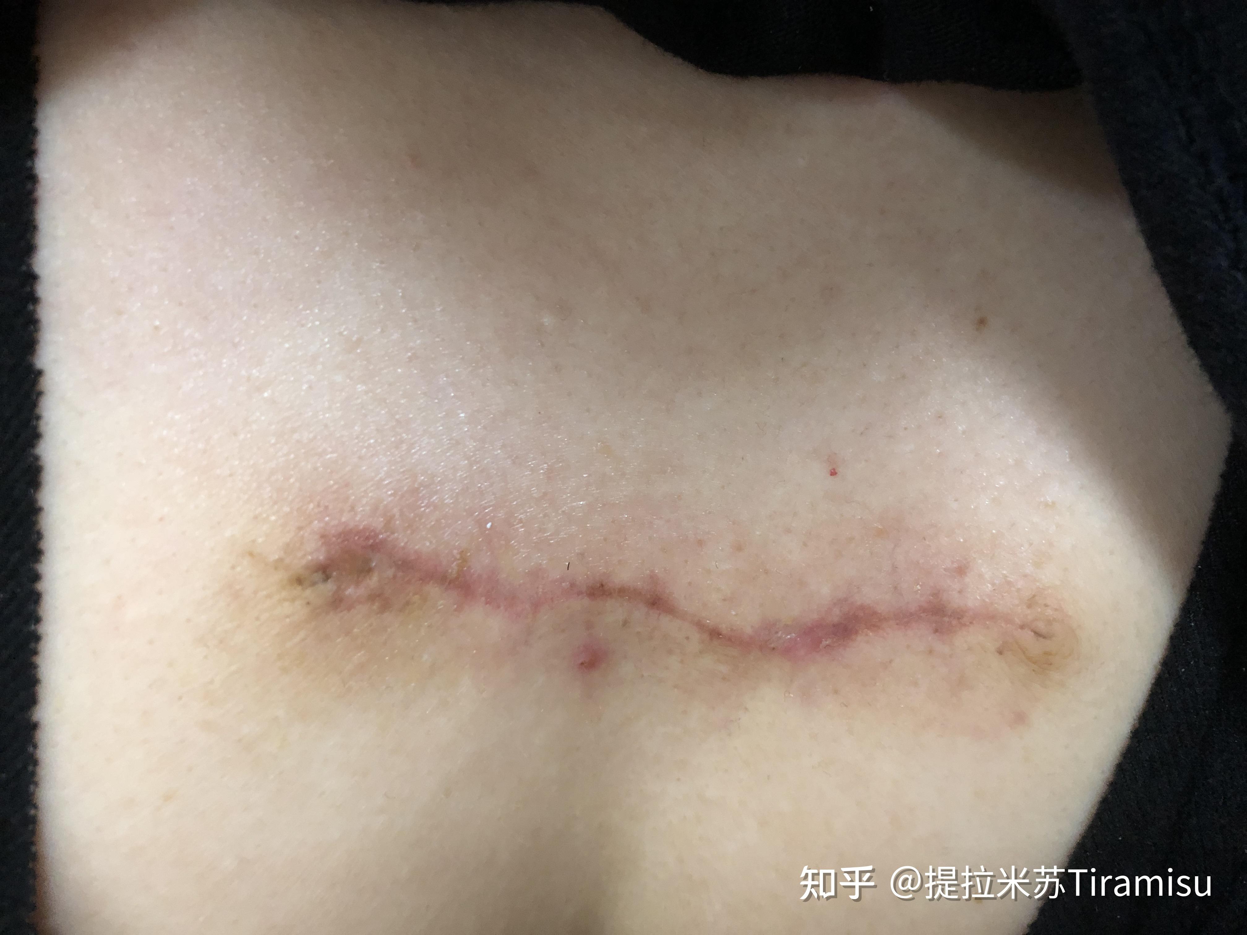 脂肪瘤手术疤痕图片