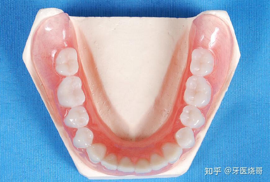 固定假牙和活动假牙哪个好？ - 知乎