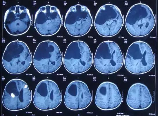 3岁儿童鞍区蛛网膜囊肿内镜治疗后脑积水加重,历经17次失败手术,转来
