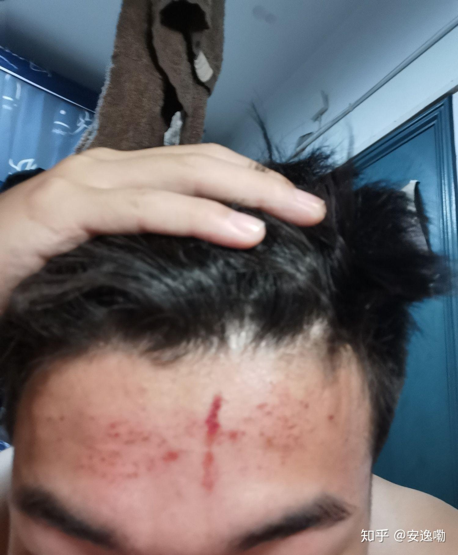 烫发药水留到额头上,额头红了一片,然后那里就变粗糙了,会留疤吗?