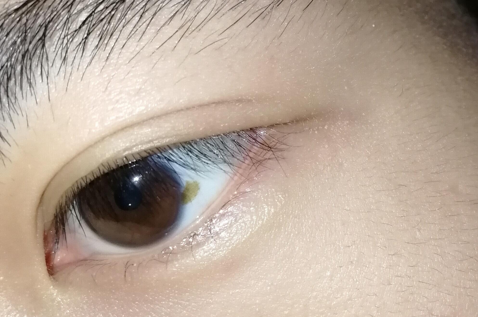 眼睛里一直有一块黄色的斑点,不知道需不需要去医院检查? 