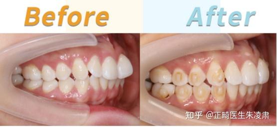 鄭州牙齒矯正前牙扭轉牙列不齊矯正後排齊上下牙列笑線更加協調