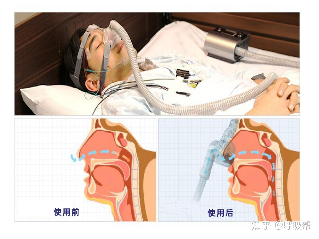 详解家用呼吸机治疗打鼾原理及作用