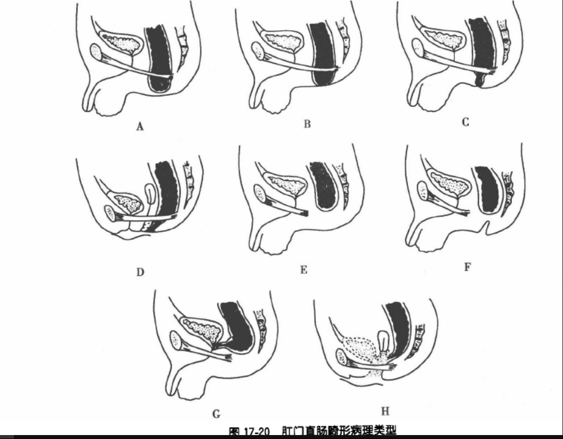 先天性肛门畸形图片图片