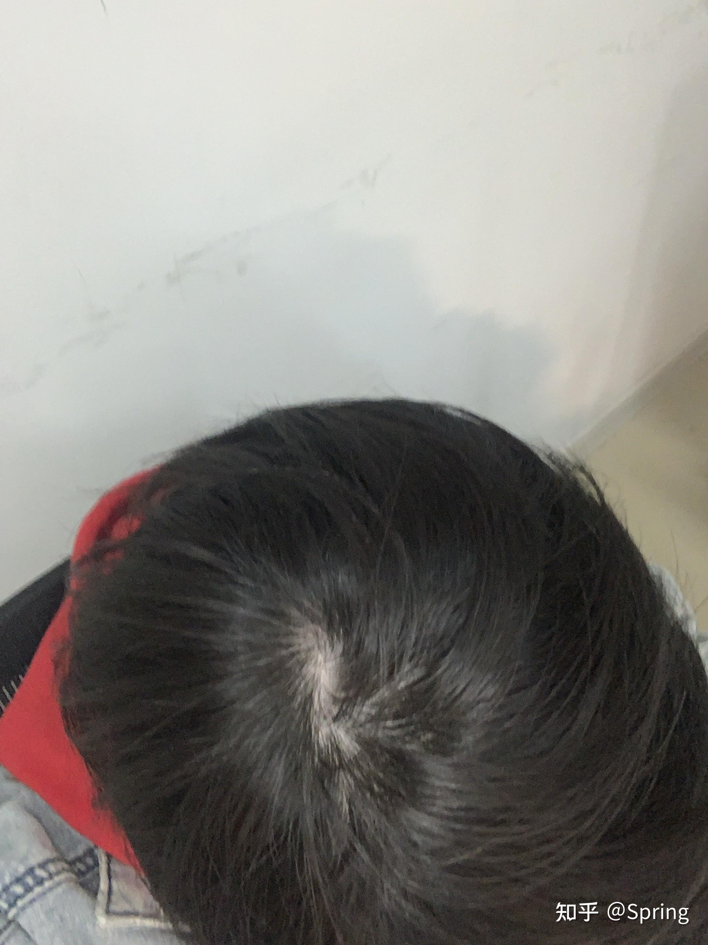 大一女生头顶秃怎么办