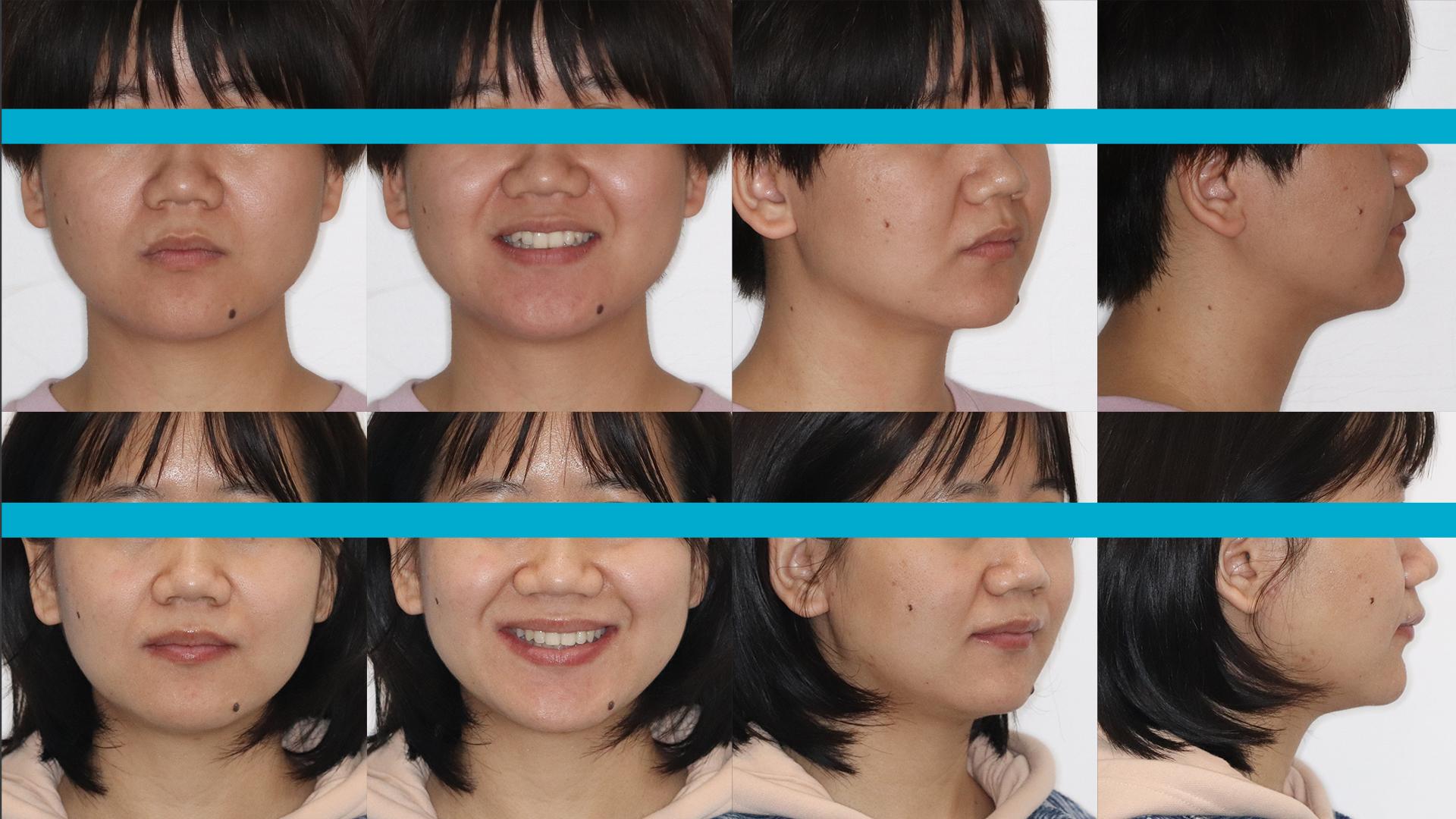 广州整牙内倾型深覆颌先天缺失一颗下中切牙如何实现完美笑容