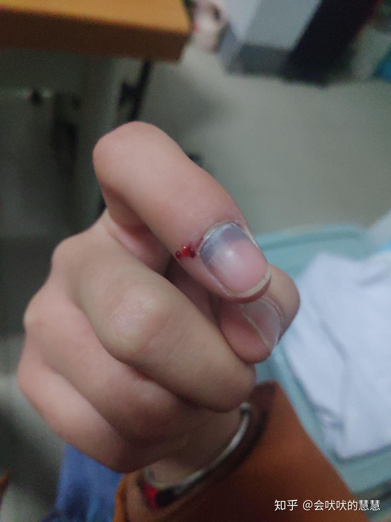 手指甲被夹到，过了一段时间，有黑色的淤血，怎么处理？ - 知乎
