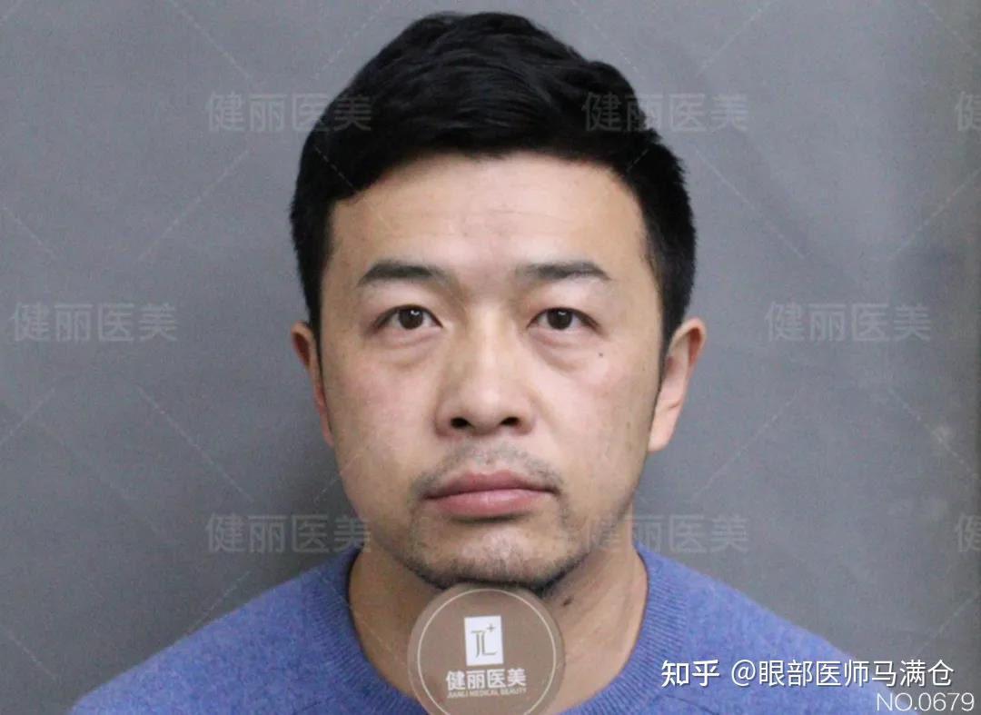 40岁男人的困扰竟是眼袋泪沟这还有救吗