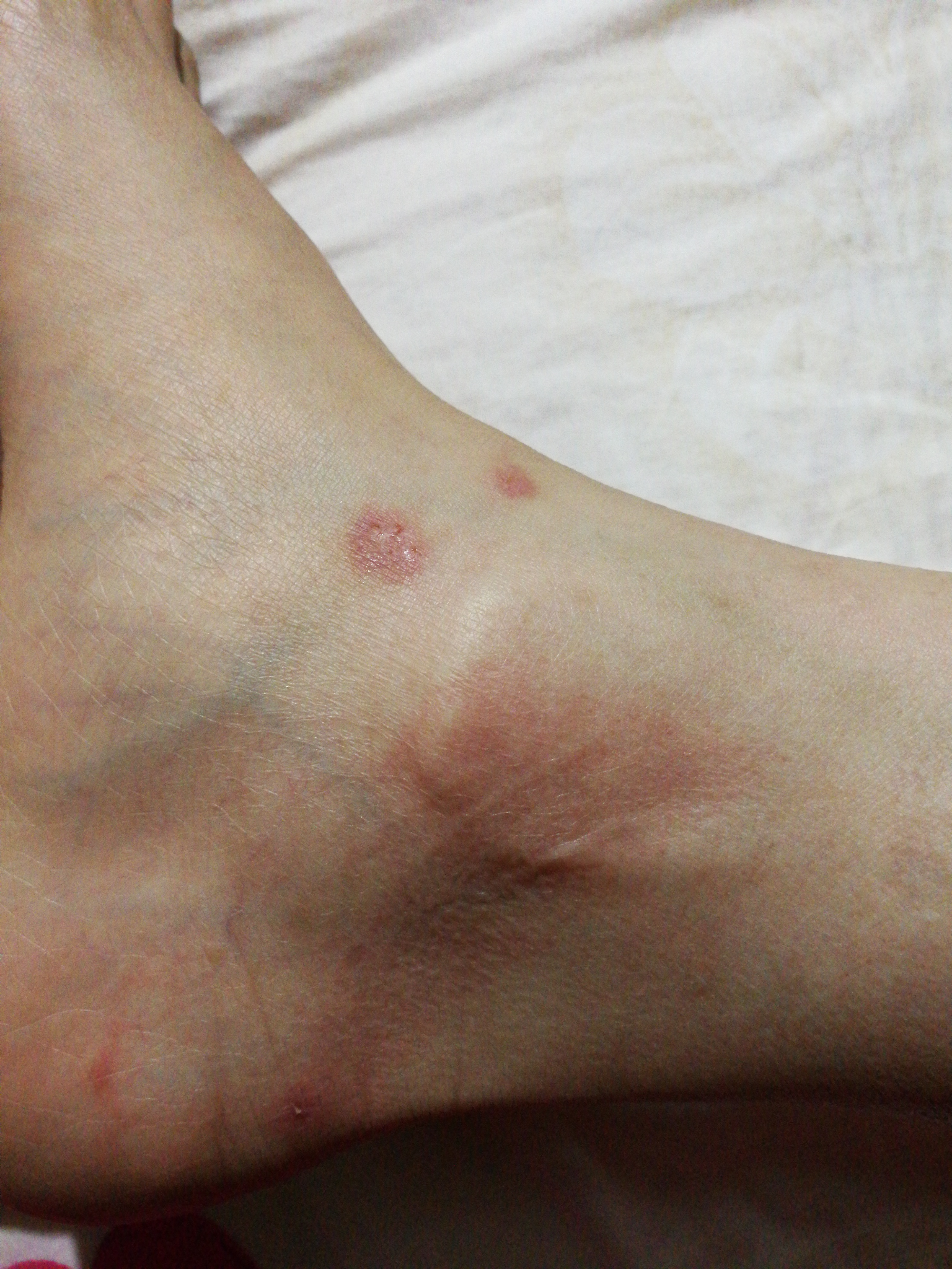 得了玫瑰糠疹怎么办? - 知乎