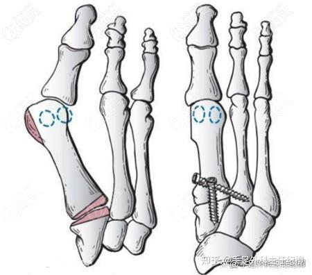 拇外翻截骨手术原理图图片