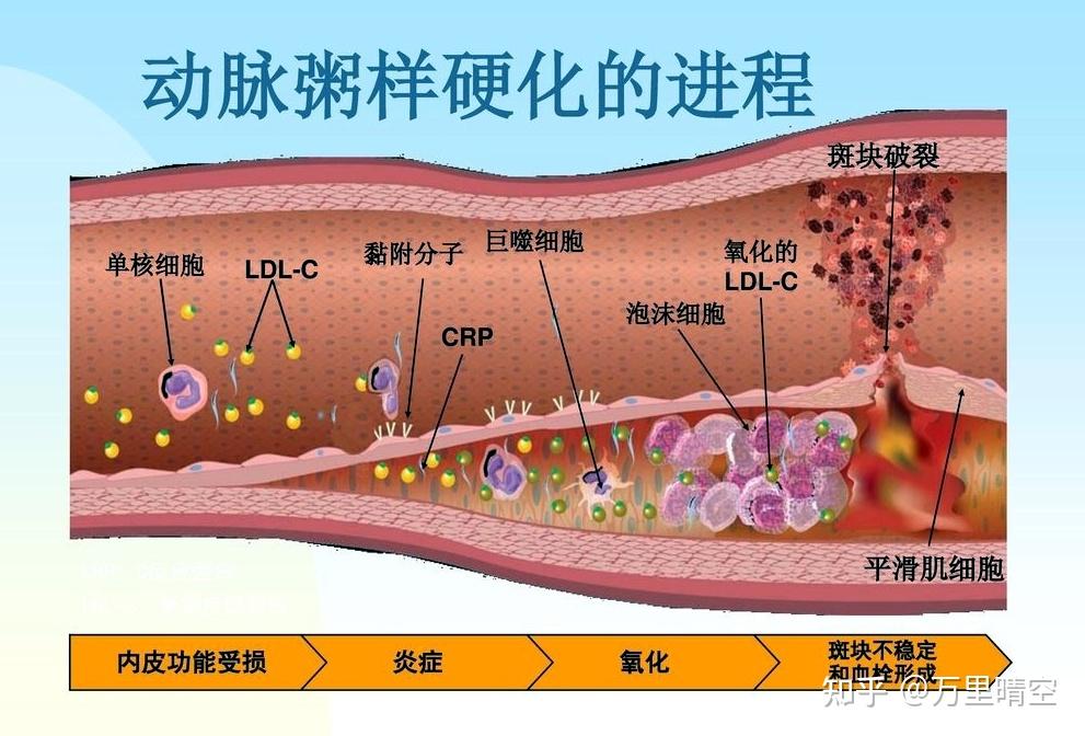 动脉粥样硬化 是指 动脉 血管内膜脂质等成分沉积,平滑肌细胞增生和