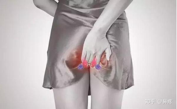 内痔疮图片_儿童肛门内痔疮图片|520常识网