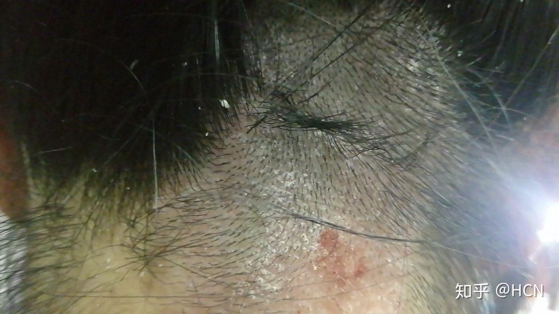 头部脂溢性皮炎 偏方图片