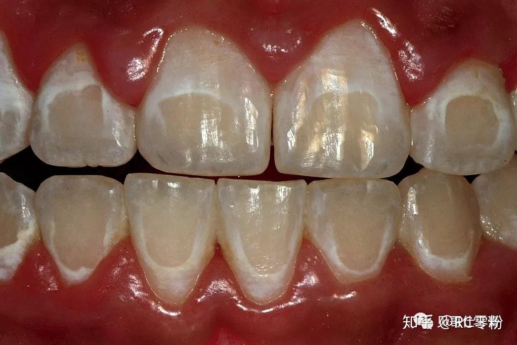 牙齿为什么会钙化图片