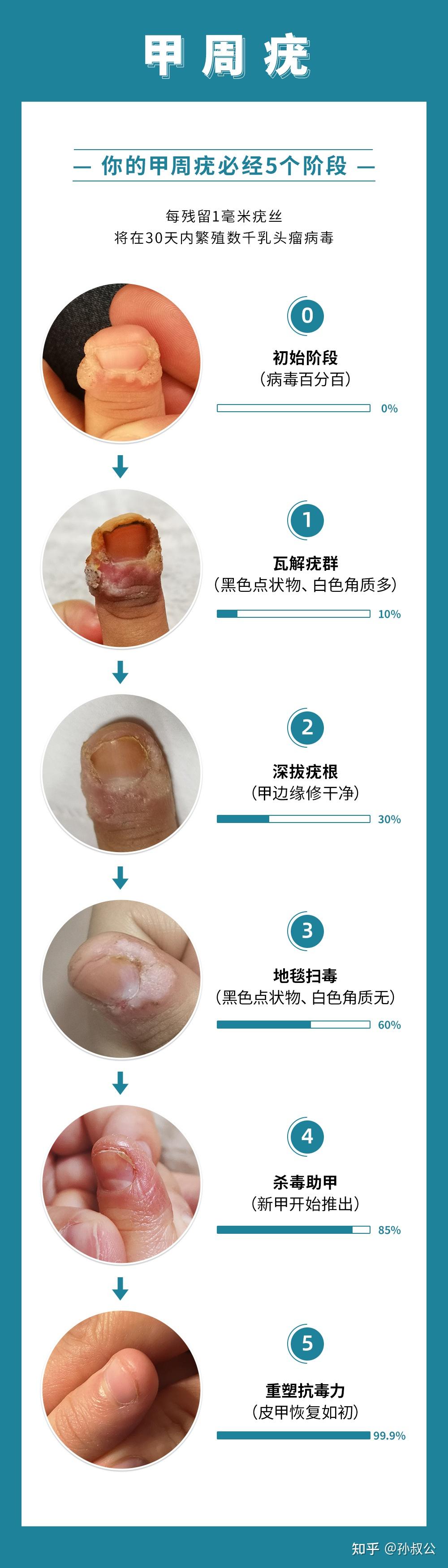 甲周疣侵蚀指甲怎么办?