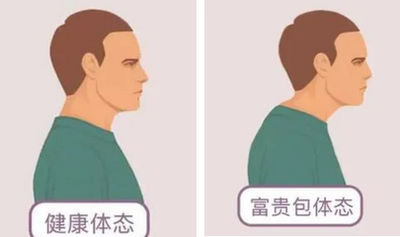 典型病例18 头前伸 富贵包 下颈段不适 - 知乎