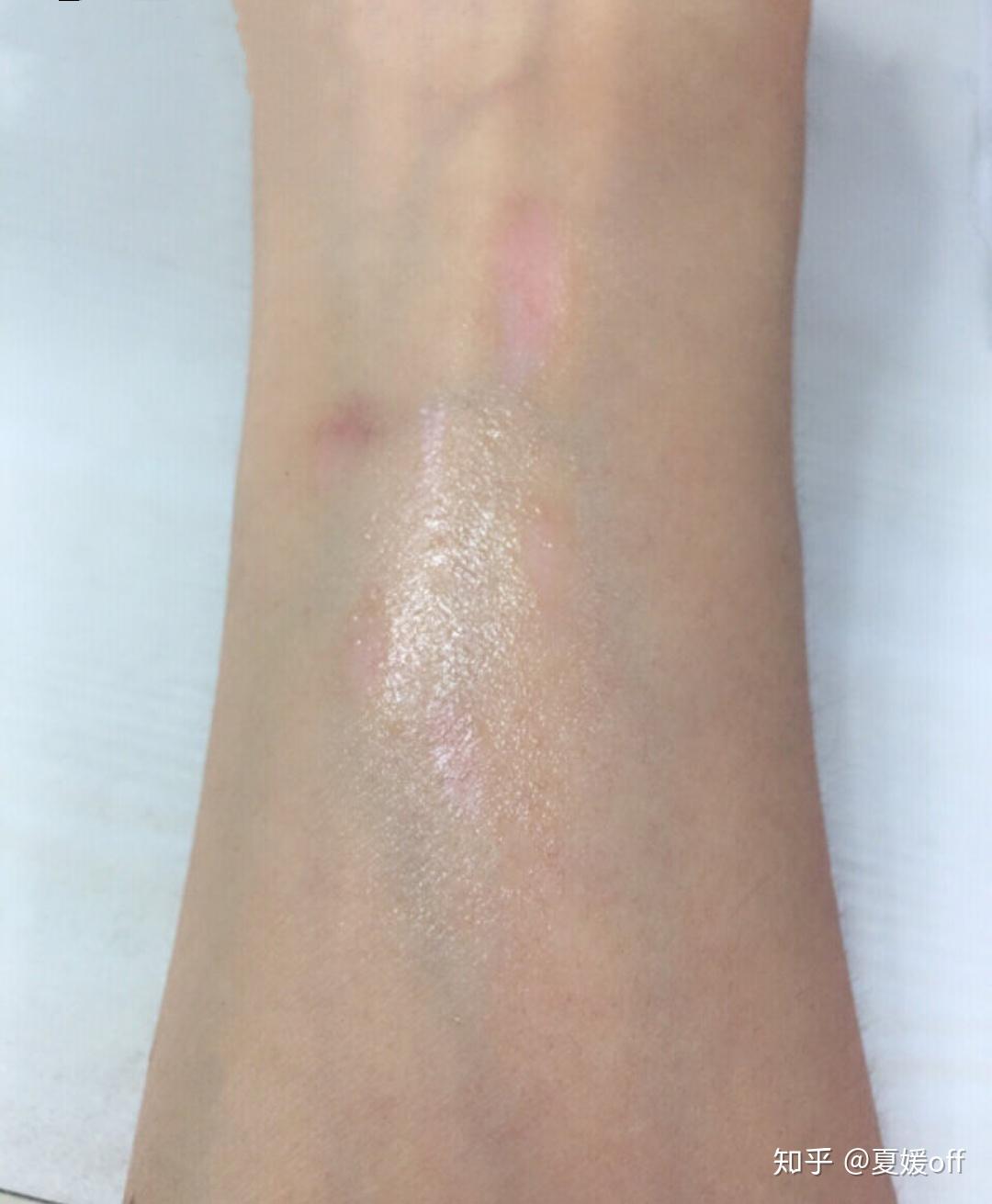【疤痕常识】不同类型的烧烫伤疤痕如何修复? - 知乎