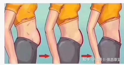骨盆前倾有矫正成功的例子吗