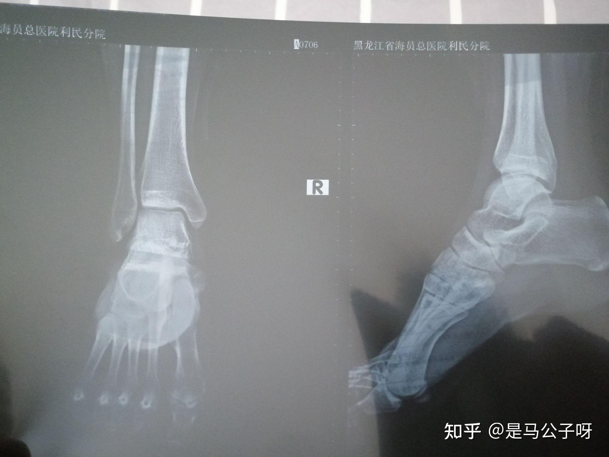 儿童内踝骨骺x线图片图片