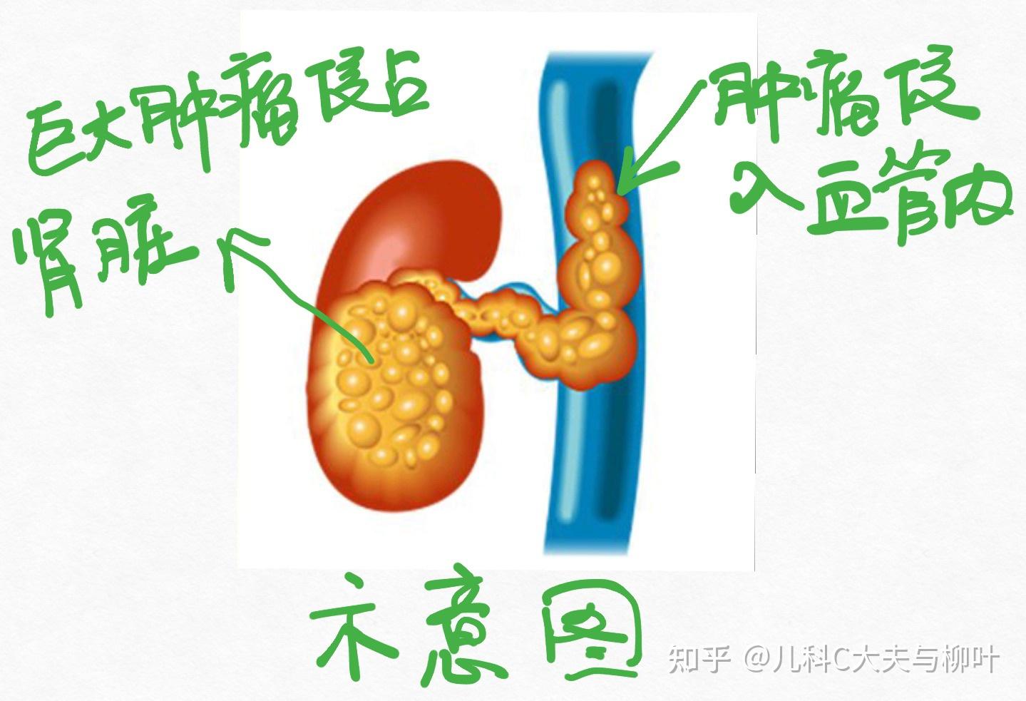医院儿童肿瘤外科再次成功完成一例罕见的肾母细胞瘤伴发巨大静脉癌栓