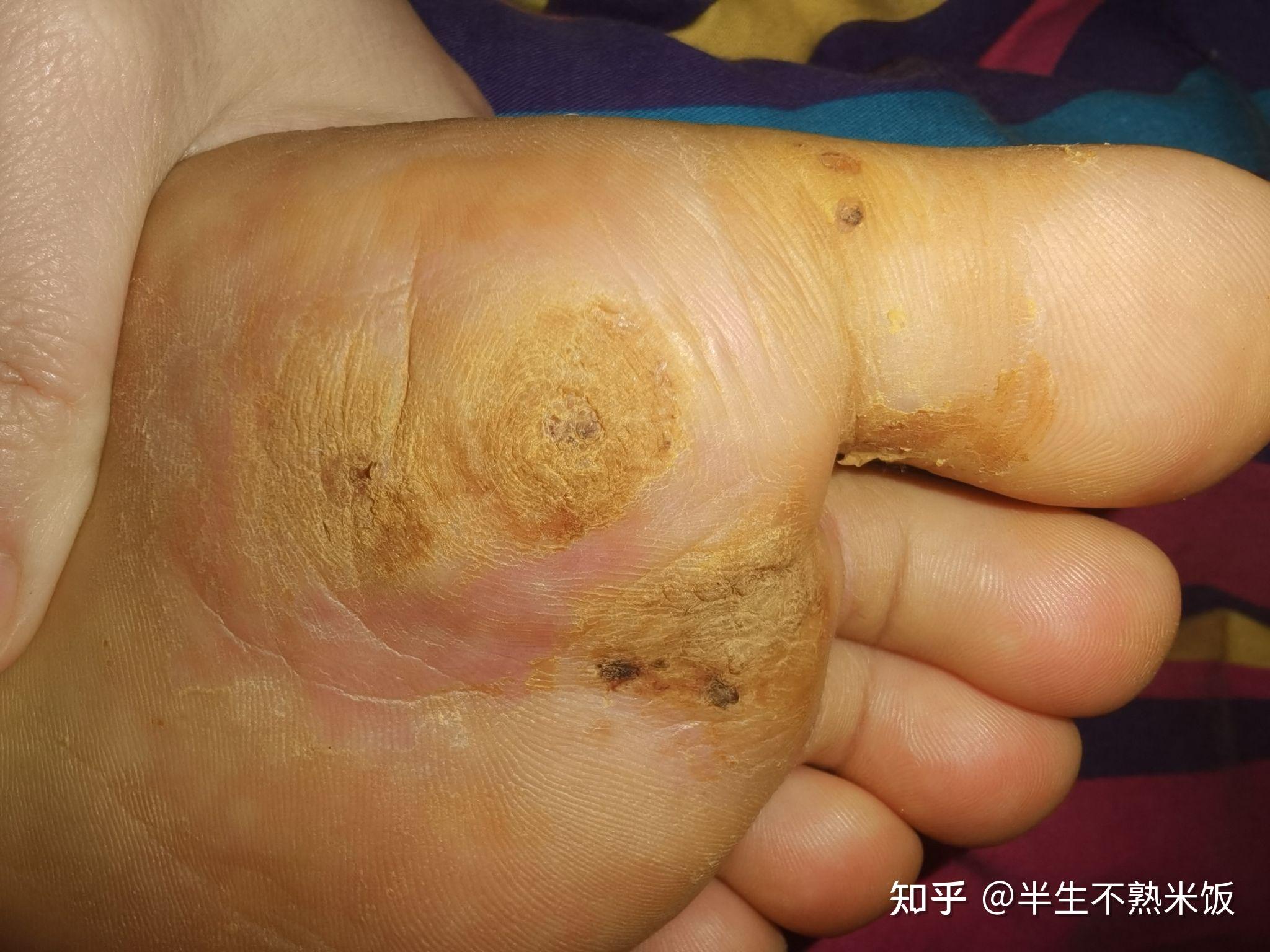 两年的治疗跖疣记录持续更新