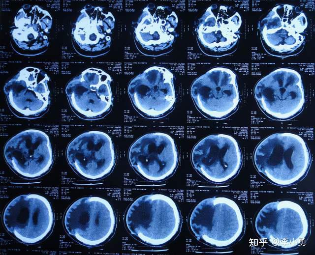 腦外傷治1年半仍無效腦積水腦膨出先後行腦室腹腔分流術電子腦室鏡術