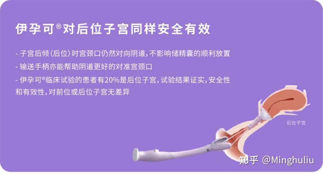 子宫后位怎么了,我照样好孕!~ - 知乎