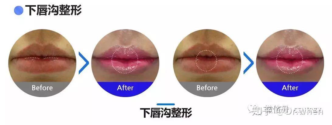 M唇手术详情 - 知乎