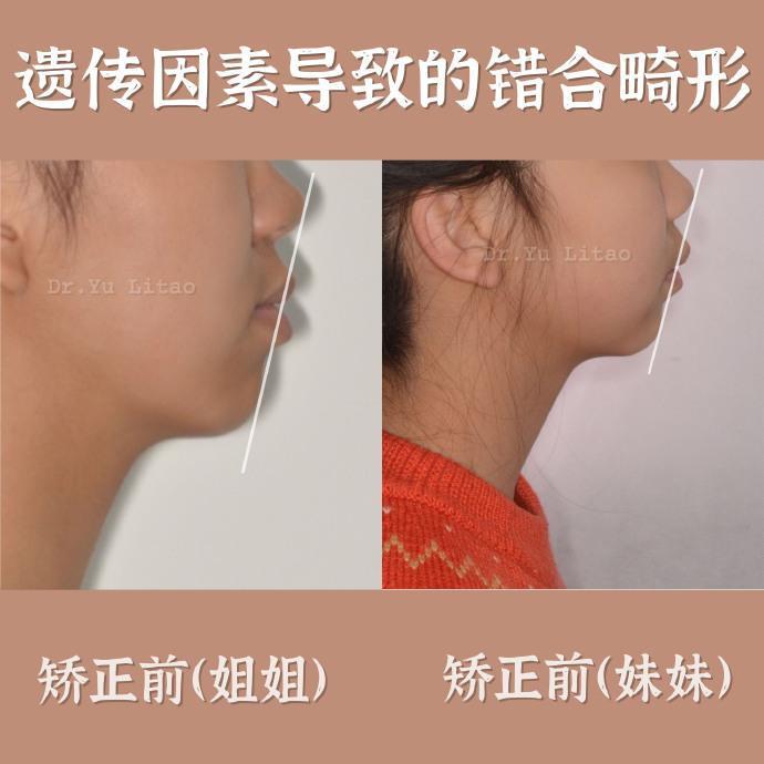 太原牙齿矫正论遗传因素错颌畸形应及早进行正畸完成颜面管理重要性